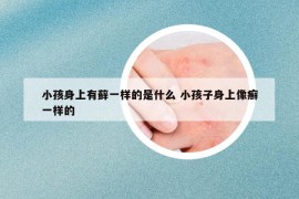 小孩身上有藓一样的是什么 小孩子身上像癣一样的