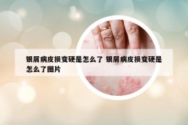 银屑病皮损变硬是怎么了 银屑病皮损变硬是怎么了图片