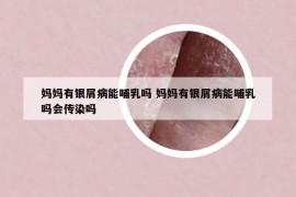 妈妈有银屑病能哺乳吗 妈妈有银屑病能哺乳吗会传染吗