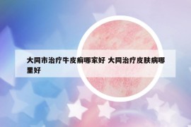 大同市治疗牛皮癣哪家好 大同治疗皮肤病哪里好