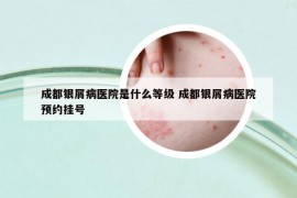 成都银屑病医院是什么等级 成都银屑病医院预约挂号