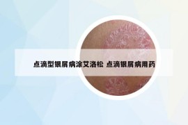 点滴型银屑病涂艾洛松 点滴银屑病用药
