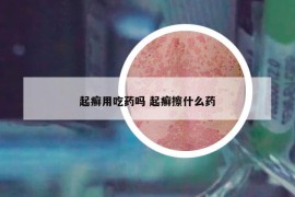 起癣用吃药吗 起癣擦什么药