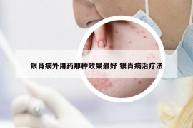 银肖病外用药那种效果最好 银肖病治疗法