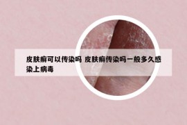 皮肤癣可以传染吗 皮肤癣传染吗一般多久感染上病毒