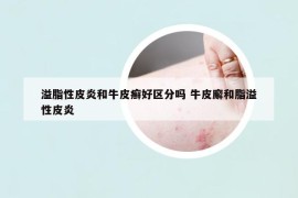溢脂性皮炎和牛皮癣好区分吗 牛皮廨和脂溢性皮炎