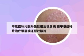 甲氨蝶呤片配叶酸能根治银屑病 用甲氨蝶呤片治疗银屑病还服叶酸片