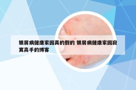 银屑病健康家园真的假的 银屑病健康家园寂寞高手的博客