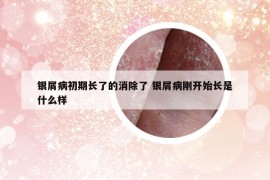 银屑病初期长了的消除了 银屑病刚开始长是什么样