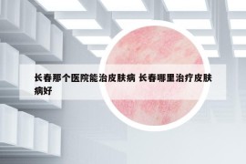 长春那个医院能治皮肤病 长春哪里治疗皮肤病好
