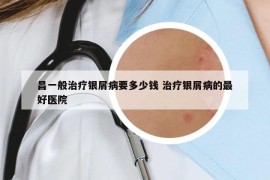 昌一般治疗银屑病要多少钱 治疗银屑病的最好医院