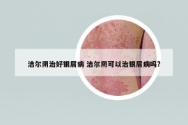 洁尔阴治好银屑病 洁尔阴可以治银屑病吗?