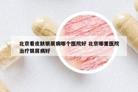 北京看皮肤银屑病哪个医院好 北京哪里医院治疗银屑病好