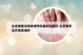 北京哪里治银屑病专科最好的医院 北京哪家治疗银屑病好