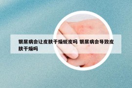 银屑病会让皮肤干燥蜕皮吗 银屑病会导致皮肤干燥吗