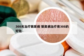 308光治疗银屑病 银屑病治疗用308的好处