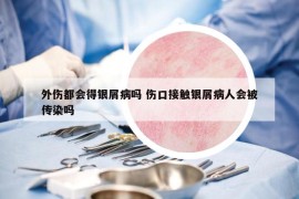 外伤都会得银屑病吗 伤口接触银屑病人会被传染吗