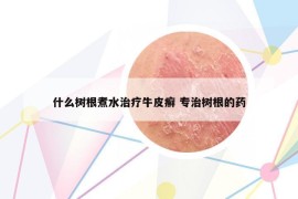 什么树根煮水治疗牛皮癣 专治树根的药