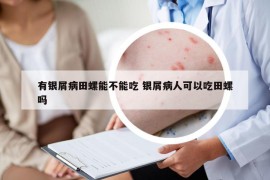 有银屑病田螺能不能吃 银屑病人可以吃田螺吗
