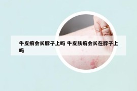 牛皮癣会长脖子上吗 牛皮肤癣会长在脖子上吗