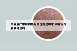淘宝治疗银屑病最好的医院是哪家 淘宝治疗脱发可信吗
