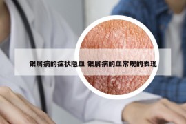 银屑病的症状隐血 银屑病的血常规的表现