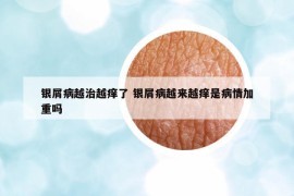 银屑病越治越痒了 银屑病越来越痒是病情加重吗
