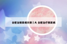 合肥治银屑病方便軍大 合肥治疗银屑病