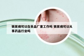 银屑病可以在食品厂里工作吗 银屑病可以从事药品行业吗