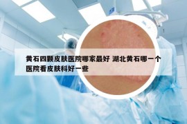 黄石四颗皮肤医院哪家最好 湖北黄石哪一个医院看皮肤科好一些