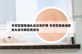 寻常型银屑病头皮日常护理 寻常型银屑病累及头皮时典型表现为
