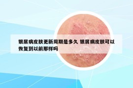 银屑病皮肤更新周期是多久 银屑病皮肤可以恢复到以前那样吗
