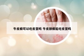 牛皮癣可以吃皮蛋吗 牛皮肤癣能吃皮蛋吗
