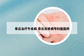 章丘治疗牛皮癣 章丘皮肤病专科医医院