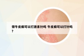 得牛皮癣可以打激素针吗 牛皮癣可以打针吗?