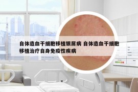 自体造血干细胞移植银屑病 自体造血干细胞移植治疗自身免疫性疾病