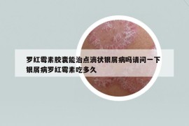 罗红霉素胶囊能治点滴状银屑病吗请问一下 银屑病罗红霉素吃多久
