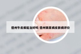 德州牛皮癣能治好吗 德州银屑病皮肤病评价