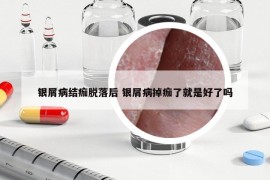 银屑病结痂脱落后 银屑病掉痂了就是好了吗