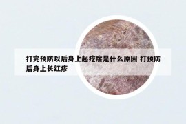 打完预防以后身上起疙瘩是什么原因 打预防后身上长红疹