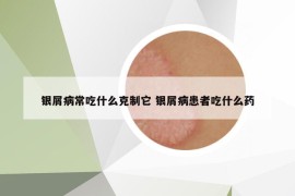 银屑病常吃什么克制它 银屑病患者吃什么药