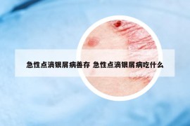 急性点滴银屑病善存 急性点滴银屑病吃什么