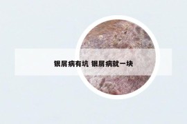 银屑病有坑 银屑病就一块