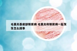 毛囊炎基底部银屑病 毛囊炎和银屑病一起发生怎么回事