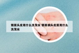 银屑头皮用什么洗发水 银屑病头皮屑用什么洗发水