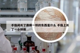 手指间长了像癣一样的东西是什么 手指上长了一小块癣