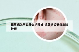 银屑病关节炎什么护理好 银屑病关节炎皮肤护理