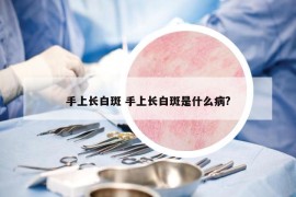 手上长白斑 手上长白斑是什么病?