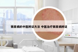 银屑病的中医辨证方法 中医治疗银屑病辨证