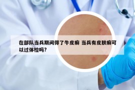 在部队当兵期间得了牛皮癣 当兵有皮肤癣可以过体检吗?
